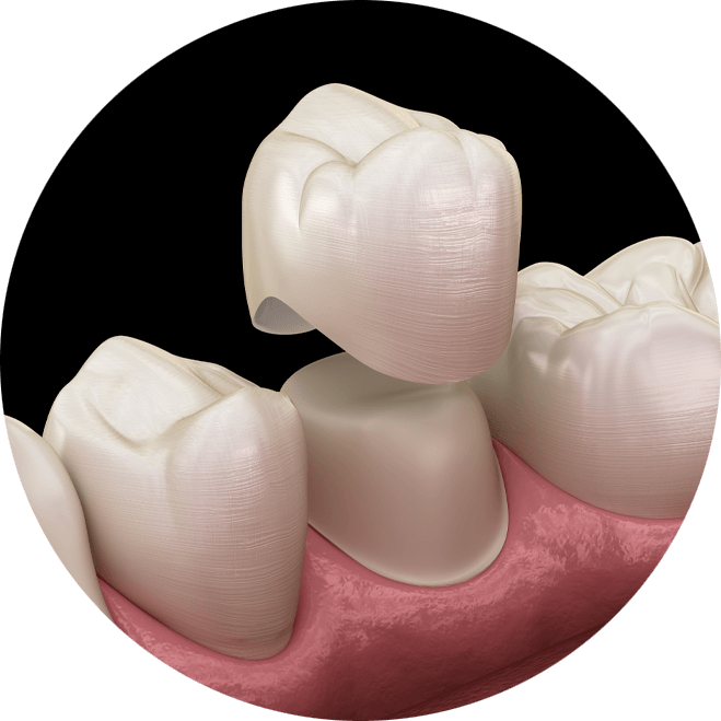 dental crown model