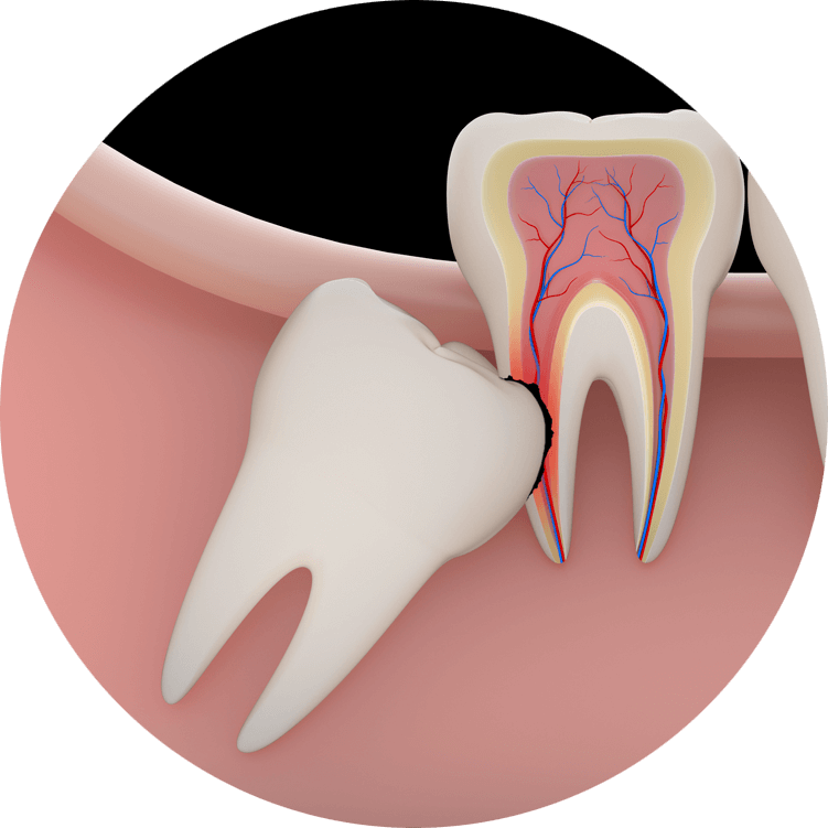 impacted tooth graphic
