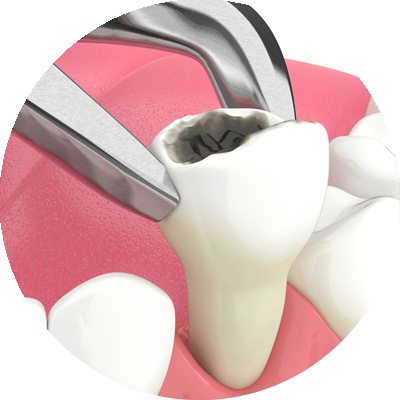 tooth extraction 3d model