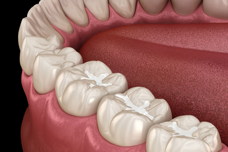 a 3D model of teeth and gums with dental sealant.