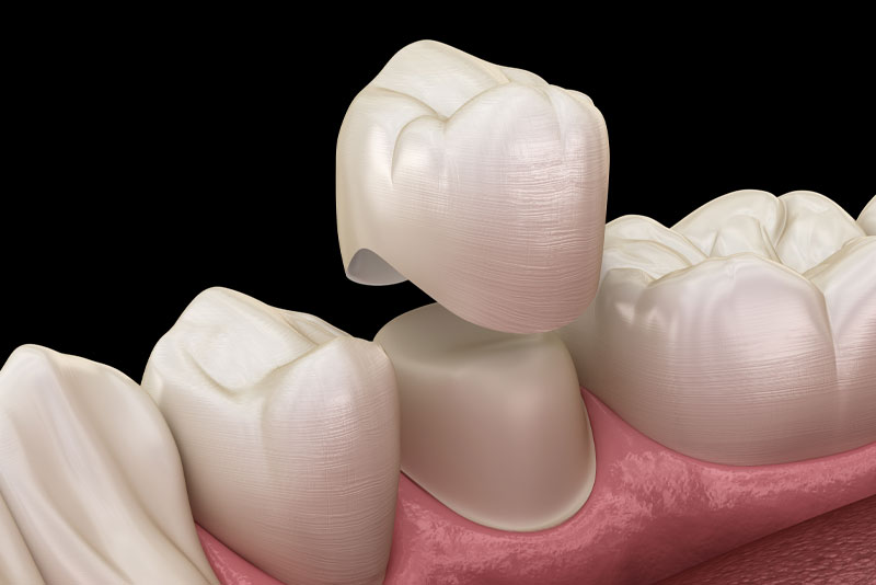 dental crowns in reno, nevada.