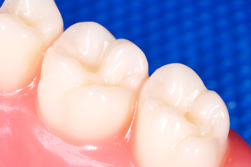 dental crowns in mouth.