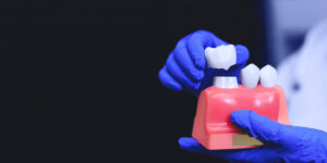 Discover our expertly crafted dental crown model featuring three teeth, demonstrating the precision and care in our dental restoration services.