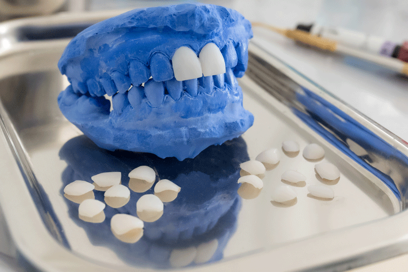 Dental veneers on a blue mouth model in the laboratory