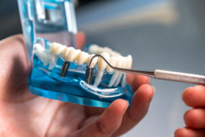 Dive into the essential role that tooth posts play in dental implants. Learn why they're crucial, how they’re placed today!