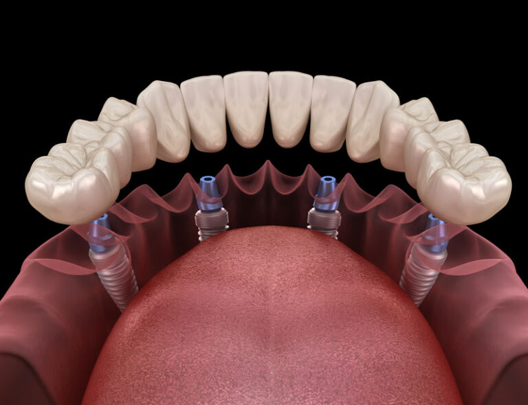 Your Guide To Full Mouth Teeth Implants 2025 | David M. White, DDS